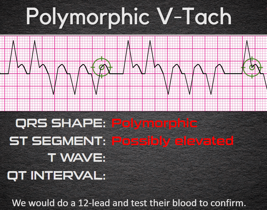 Polymorphic V-Tach ECG with possibly elevated ST segment.